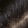 Rahasia Rambut Bebas Ketombe: Tips Perawatan yang Tepat