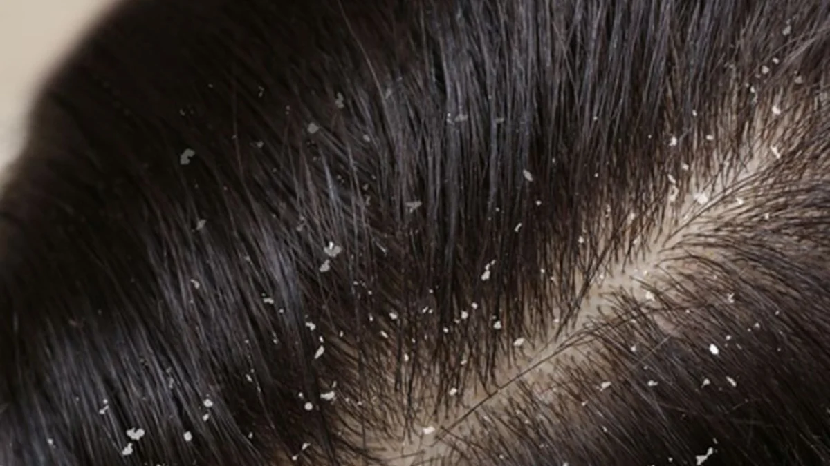 Rahasia Rambut Bebas Ketombe: Tips Perawatan yang Tepat