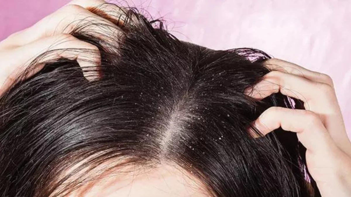 Mengatasi Ketombe Bandel Pada Rambut: Fakta, Penyebab, dan Solusi Efektif