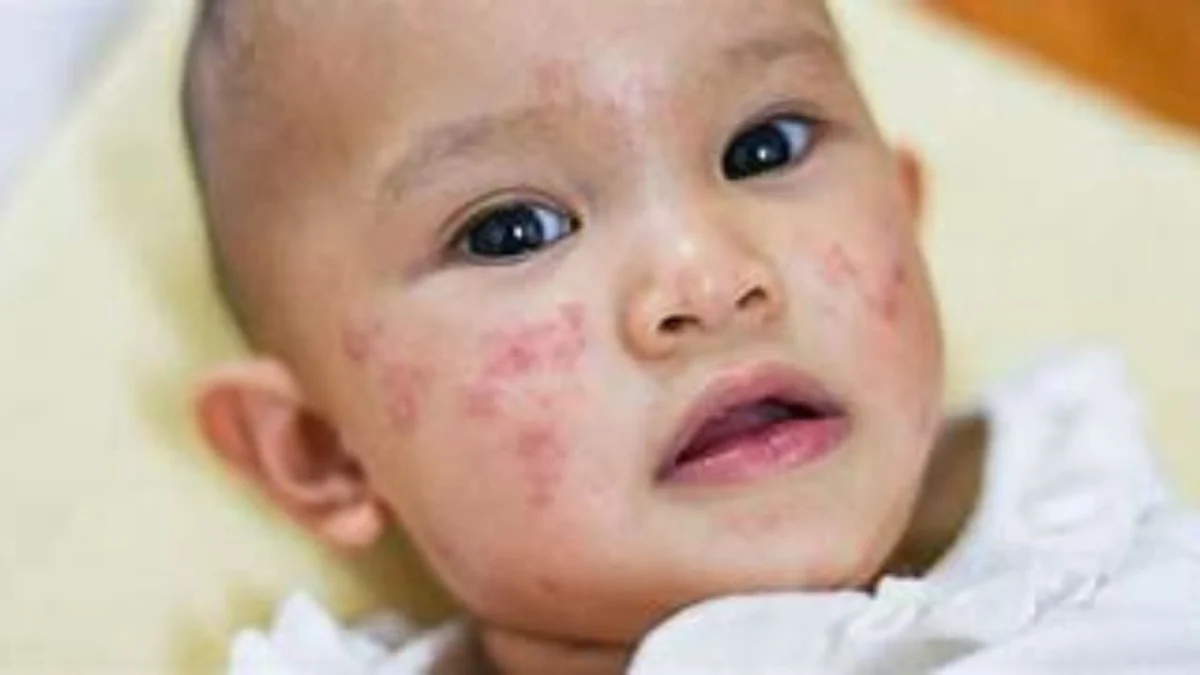 Pemahaman Alergi Gatal: Penyebab dan Gejala
