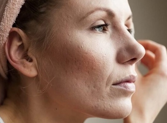 Merawat Pori-Pori Wajah: Tips untuk Kulit yang Sehat dan Bersinar